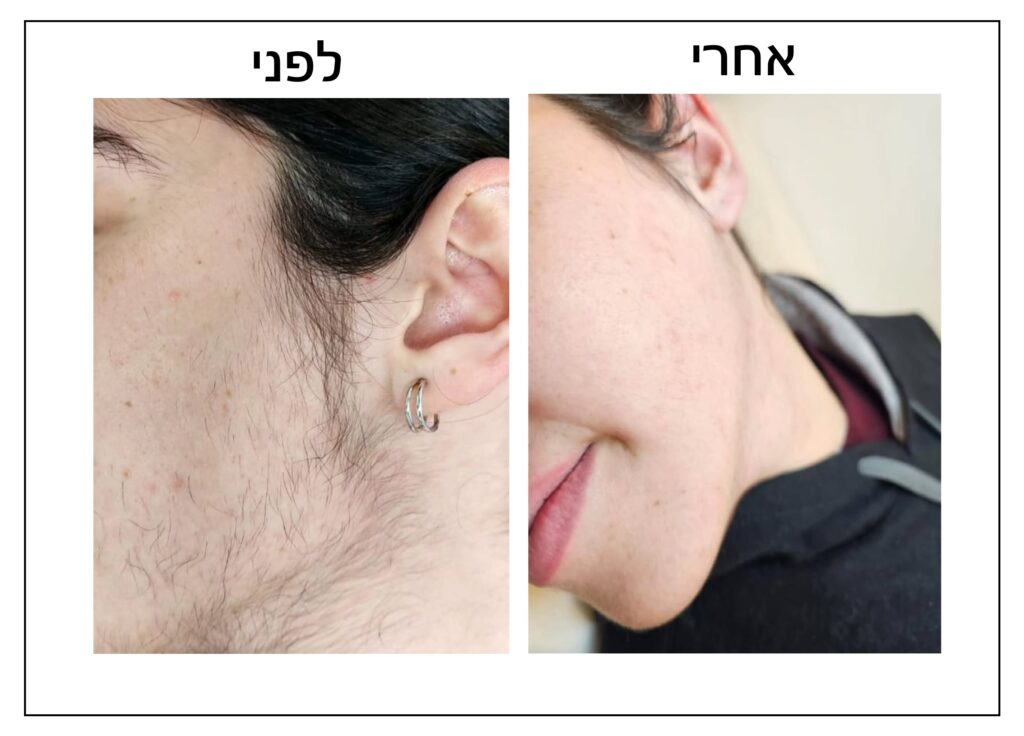 תמונה מפוצלת המציגה את תוצאות הסרת שיער הפנים על הלחי וקו הלסת של אדם, עם הכיתוב "לפני" ו"אחרי" בעברית.