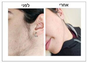 תמונה מפוצלת המציגה את תוצאות הסרת שיער הפנים על הלחי וקו הלסת של אדם, עם הכיתוב "לפני" ו"אחרי" בעברית.