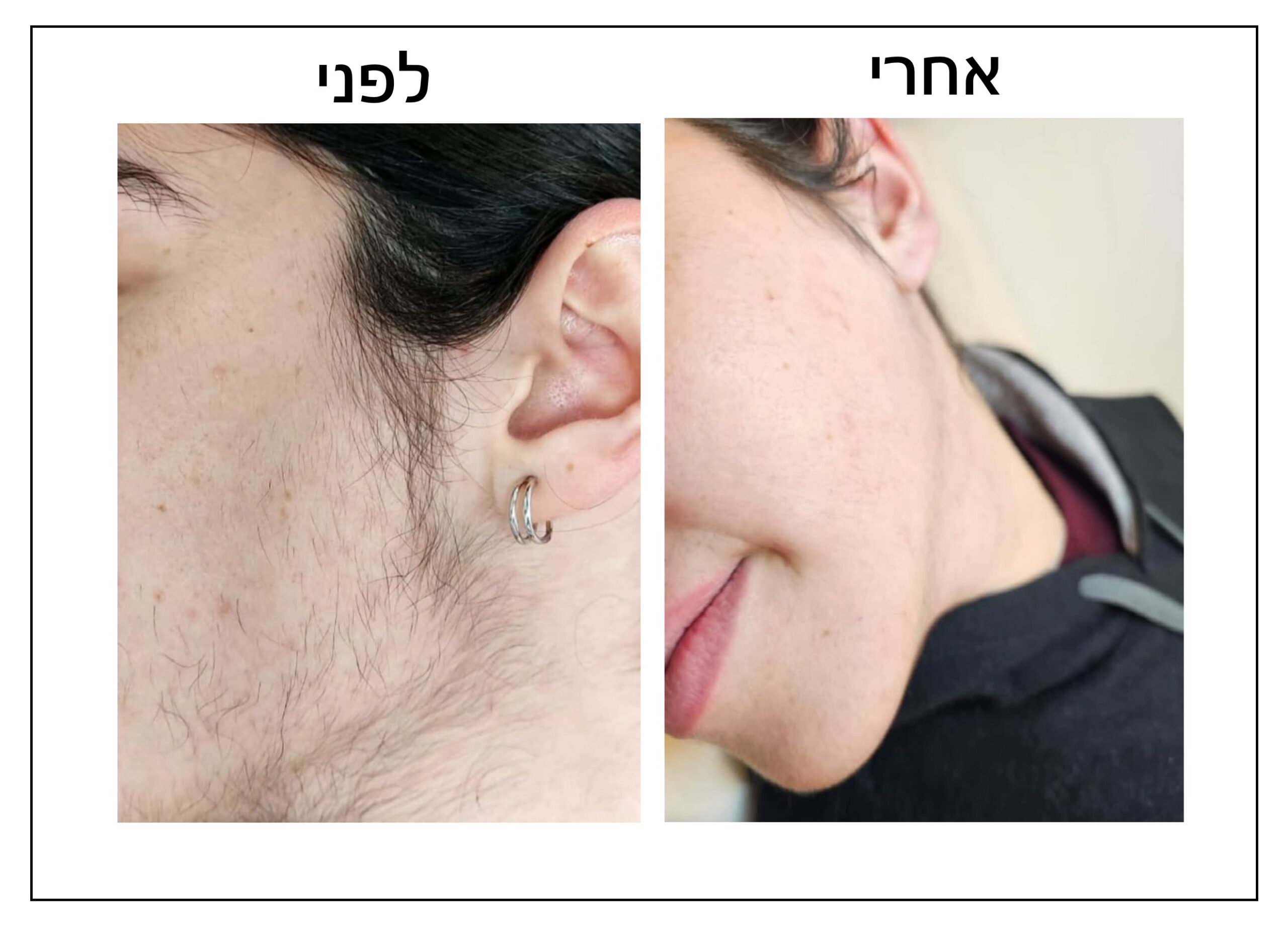 תמונה מפוצלת המציגה את תוצאות הסרת שיער הפנים על הלחי וקו הלסת של אדם, עם הכיתוב "לפני" ו"אחרי" בעברית.